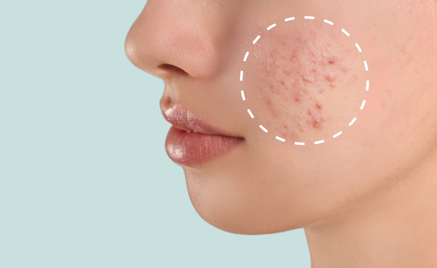 Tratamiento acné